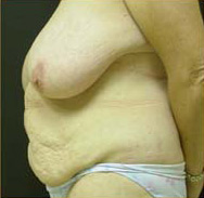 Abdominoplasty