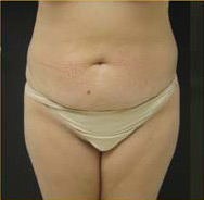 Abdominoplasty