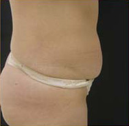 Abdominoplasty