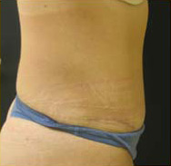 Abdominoplasty