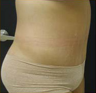 Abdominoplasty