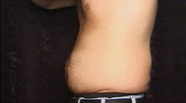 Abdominoplasty