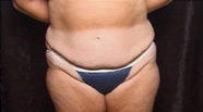 Abdominoplasty