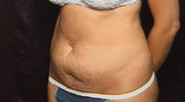 Abdominoplasty Case 3693 Before Photo Abdominoplasty