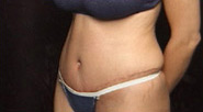 Abdominoplasty