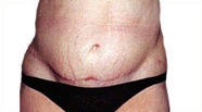 Abdominoplasty