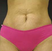 Abdominoplasty