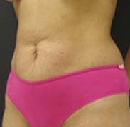 Abdominoplasty