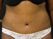 Abdominoplasty