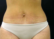 Abdominoplasty