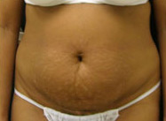 Abdominoplasty