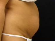 Abdominoplasty