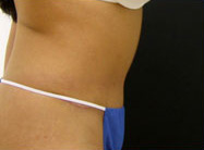 Abdominoplasty