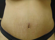 Abdominoplasty