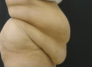 Abdominoplasty