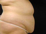 Abdominoplasty