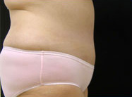 Abdominoplasty