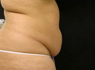 Abdominoplasty