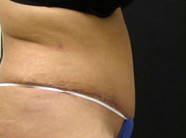 Abdominoplasty