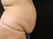 Abdominoplasty