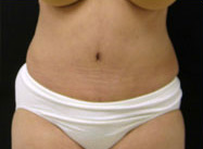 Abdominoplasty