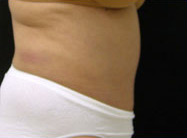 Abdominoplasty