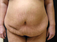 Abdominoplasty