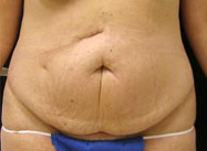 Abdominoplasty