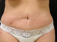 Abdominoplasty