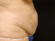 Abdominoplasty