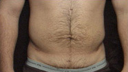 Liposuction Case 3897 After Photo Liposuction
