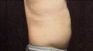 Liposuction Case 3897 Before Photo Liposuction