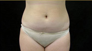 Liposuction