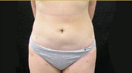 Liposuction