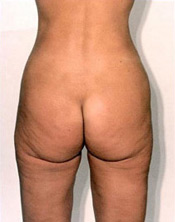 Liposuction