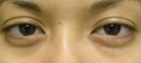 Blepharoplasty