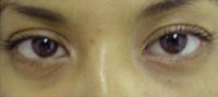 Blepharoplasty