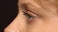 Blepharoplasty