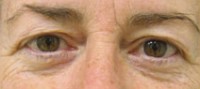 Blepharoplasty