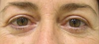 Blepharoplasty