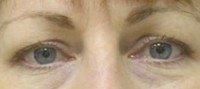 Blepharoplasty