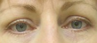 Blepharoplasty