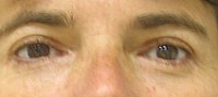 Blepharoplasty