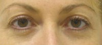 Blepharoplasty