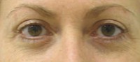 Blepharoplasty