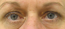 Blepharoplasty Case 3957 Before Photo Blepharoplasty