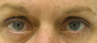 Blepharoplasty