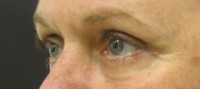 Blepharoplasty