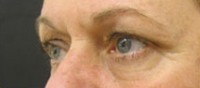 Blepharoplasty