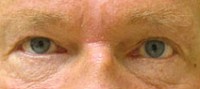 Blepharoplasty